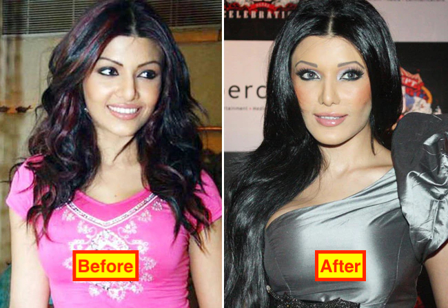 Koena Mitra Before and After surgery pics