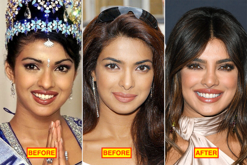 16 Bollywood Actresses Who Have Undergone Plastic Surgery 13 Priyanka chopra before and after pics after going for plastic surgery