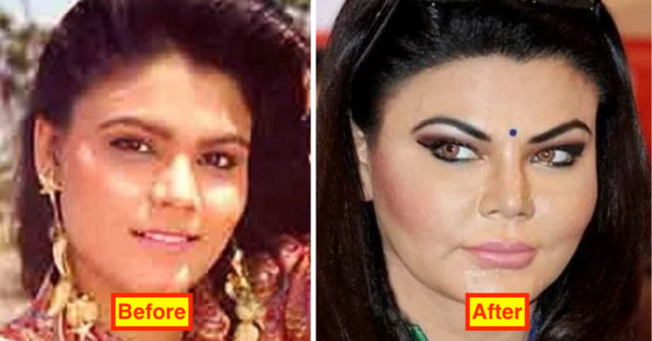 Rakhi Sawant Pics before and after plastic surgery