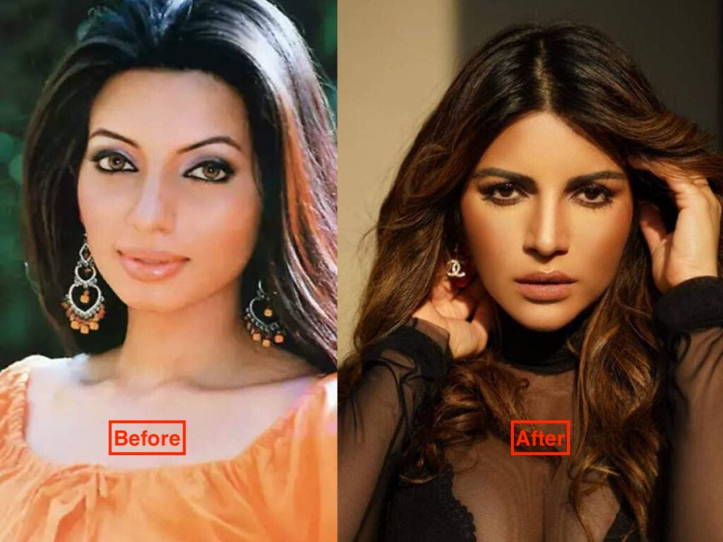 Shama Sikander Before and After plastic surgery pics