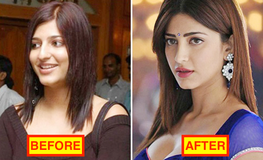 Shruti Hassan before and after pics - She went under the knife and corrected her lips and nose.