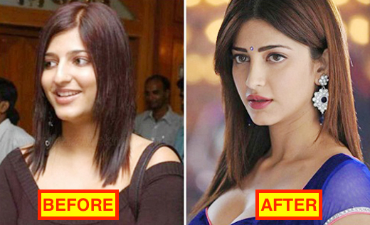 16 Bollywood Actresses Who Have Undergone Plastic Surgery 17 Shruti Hassan before and after pics - She went under the knife and corrected her lips and nose.