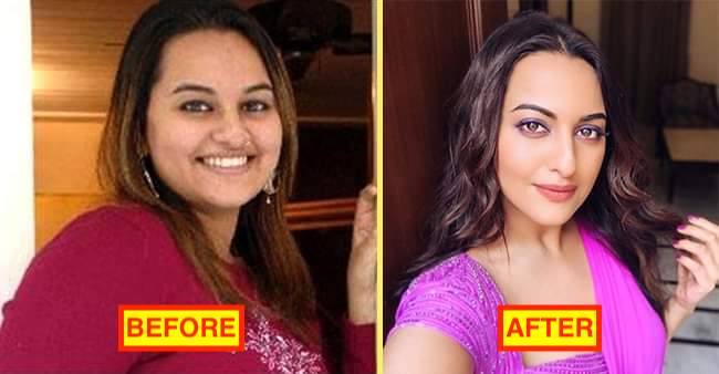 Sonakshi Sinha pics before and after cosmetic surgery.