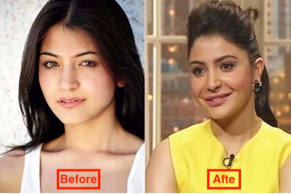 Anushka Sharma Before and After Plastic Surgery Pics