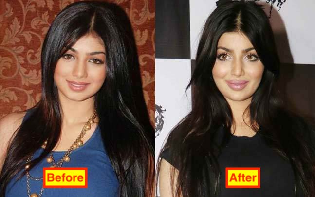 Ayesha Takia before and after plastic surgery