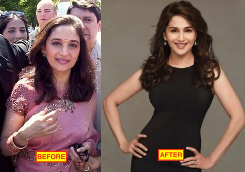 16 Bollywood Actresses Who Have Undergone Plastic Surgery 16 Madhuri dixit after doing lip, botox and face contour and other surgery