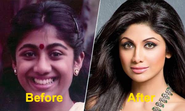 16 Bollywood Actresses Who Have Undergone Plastic Surgery 12 Shilpa Shetty before and after surgery pics